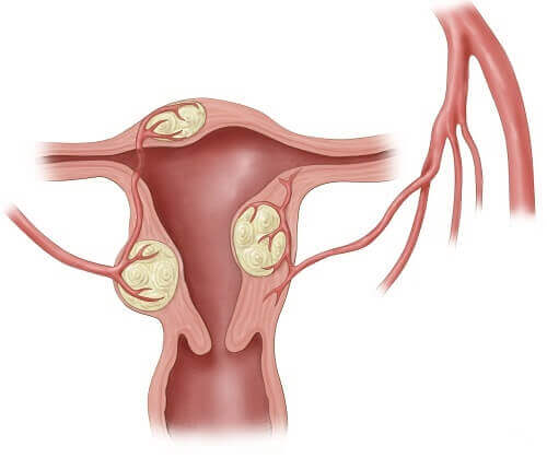 Nguyên nhân nào dẫn đến u xơ tử cung thường gặp