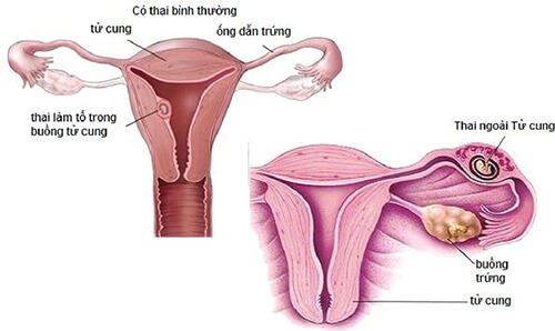 Tìm hiểu chung về bệnh viêm buồng trứng thường gặp ở phụ nữ