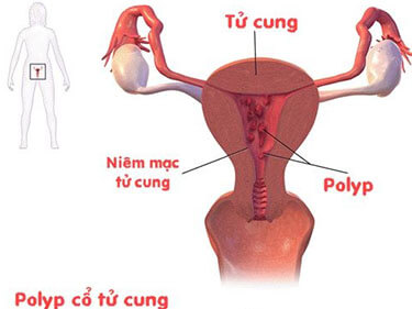 Điều trị bệnh polyp cổ tử cung như thế nào?