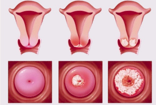 Nguyên nhân gây viêm cổ tử cung nữ giới cần phải biết