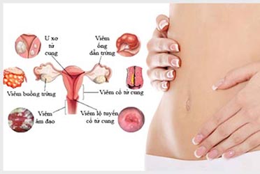 Viêm phụ khoa bệnh thường gặp ở phụ nữ