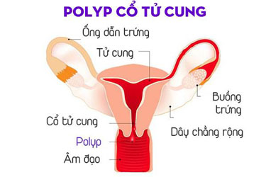 Nguyên nhân bị polyp tử cung