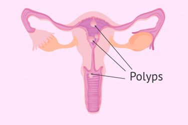 Polyp tử cung